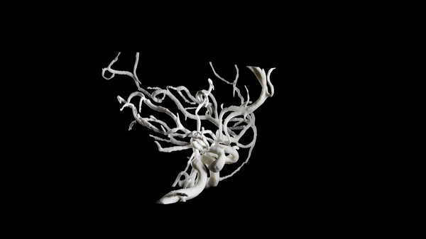 Brain blood vessels, suspected meningitis, 3D printed nylon