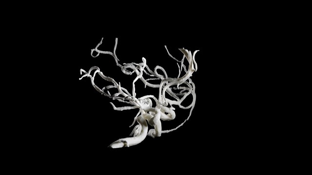 Brain blood vessels, suspected meningitis, 3D printed nylon