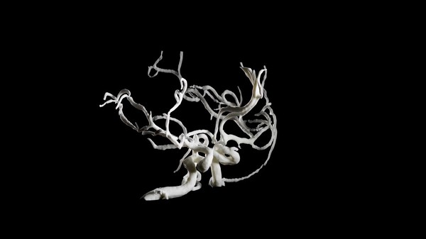 Brain blood vessels, suspected meningitis, 3D printed nylon