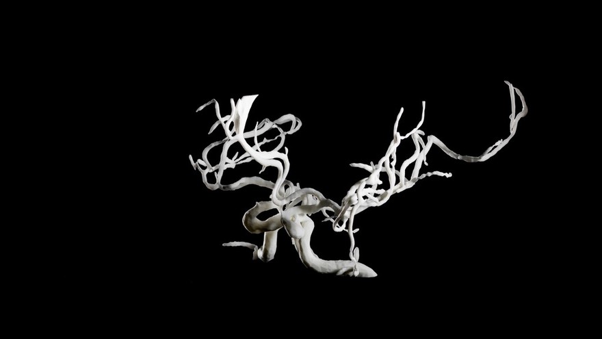 Brain blood vessels, suspected meningitis, 3D printed nylon