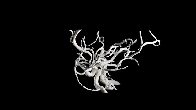 Brain blood vessels, suspected meningitis, 3D printed nylon