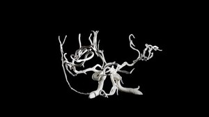 view Brain blood vessels, suspected meningitis, 3D printed nylon