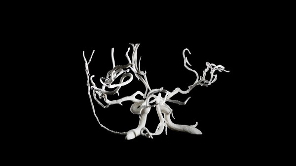 Brain blood vessels, suspected meningitis, 3D printed nylon