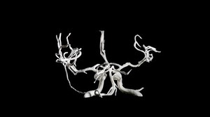 view Brain blood vessels, suspected meningitis, 3D printed nylon