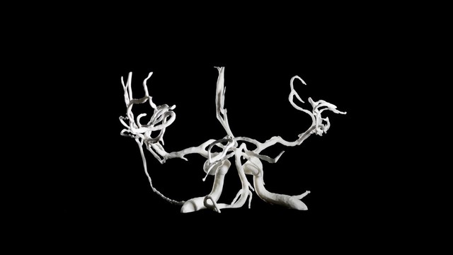 Brain blood vessels, suspected meningitis, 3D printed nylon