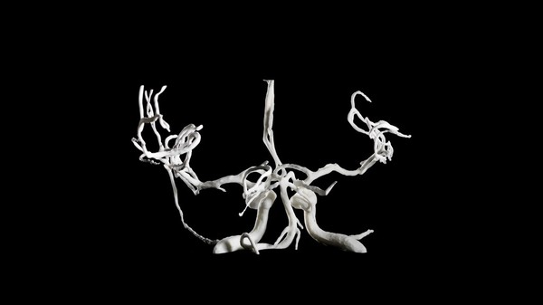 Brain blood vessels, suspected meningitis, 3D printed nylon