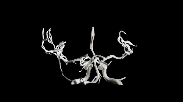 Brain blood vessels, suspected meningitis, 3D printed nylon