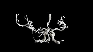 view Brain blood vessels, suspected meningitis, 3D printed nylon