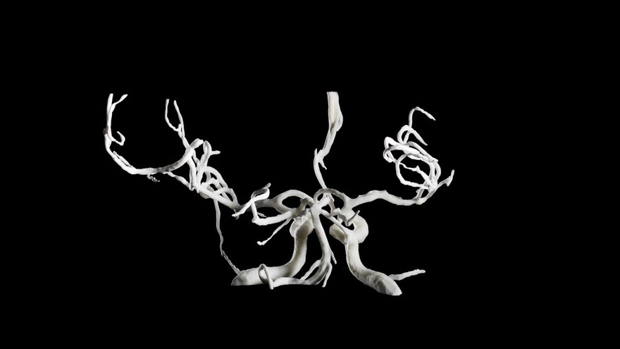 Brain blood vessels, suspected meningitis, 3D printed nylon