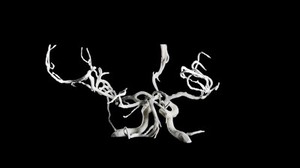 view Brain blood vessels, suspected meningitis, 3D printed nylon