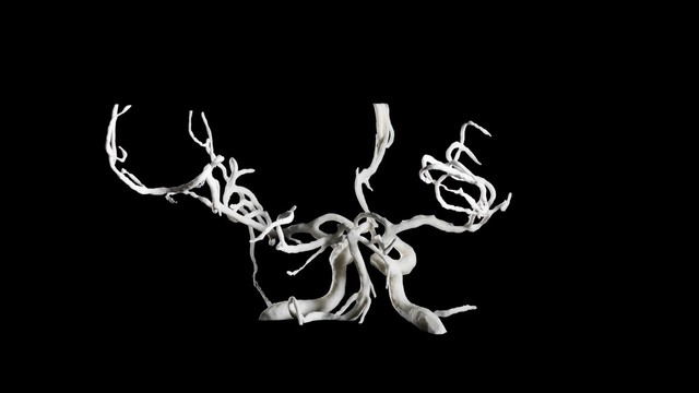 Brain blood vessels, suspected meningitis, 3D printed nylon