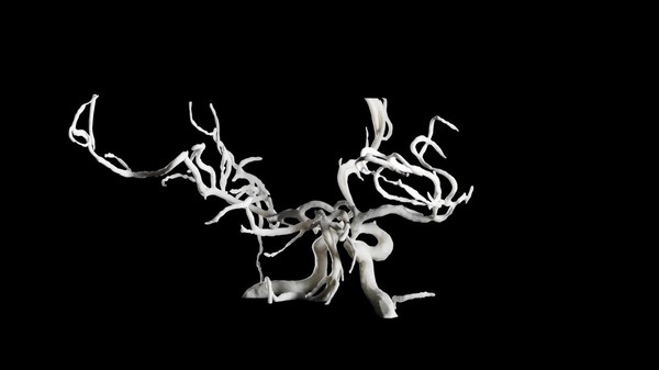 Brain blood vessels, suspected meningitis, 3D printed nylon