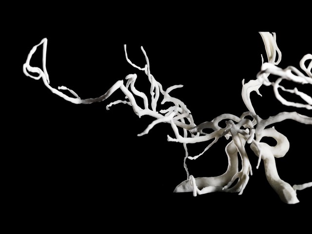 Brain blood vessels, suspected meningitis, 3D printed nylon