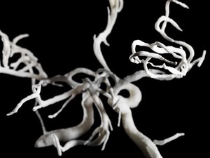 view Brain blood vessels, suspected meningitis, 3D printed nylon