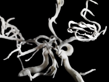 Brain blood vessels, suspected meningitis, 3D printed nylon