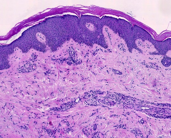 Dermatofibroma, LM