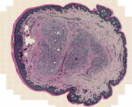 Dermatofibroma, LM