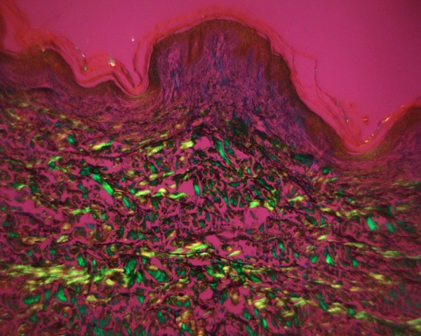 Collagen fibres in human skin, LM