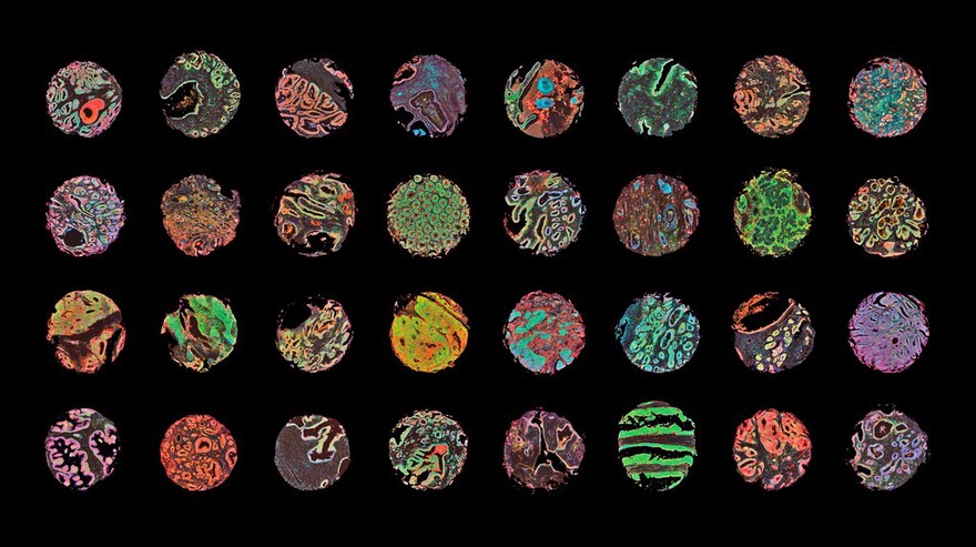 Detecting cancer in human tissues, LM