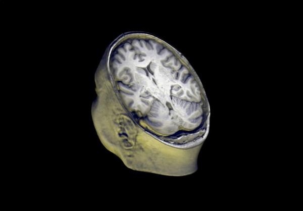 Healthy adult human head and brain viewed from behind, MRI