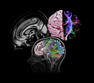 view Healthy brain, composite of tractography, MRI and artwork