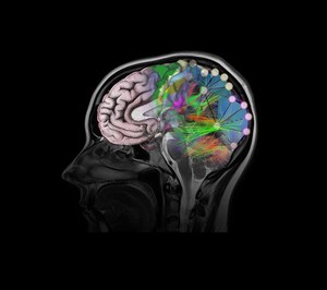 view Healthy brain, composite of tractography, MRI and artwork