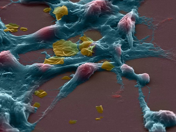 Human brain cancer stem cells treated with graphene, SEM