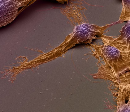 Human brain cancer stem cells, SEM