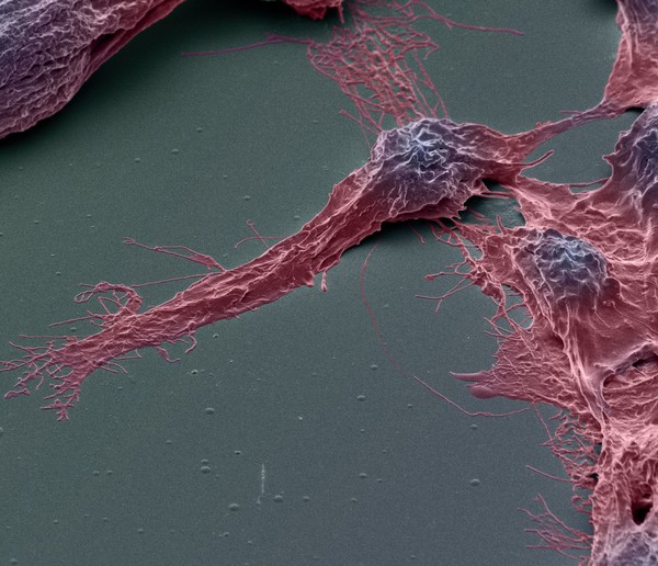 Human brain cancer stem cells, SEM