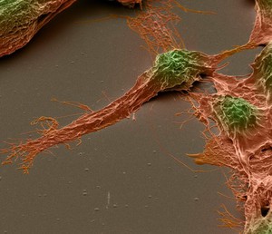 view Human brain cancer stem cells, SEM