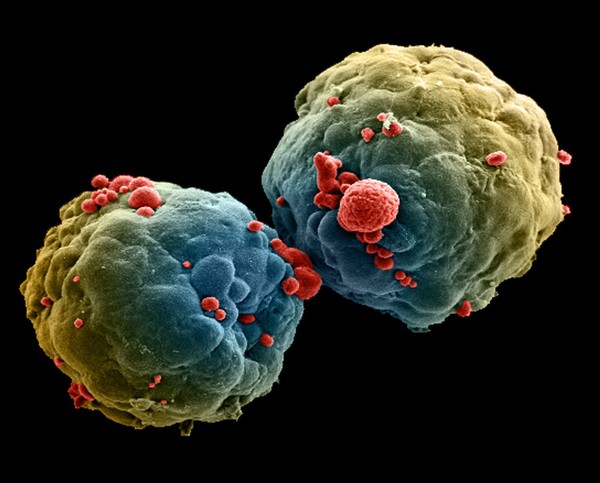 Breast cancer cell spheroid, SEM