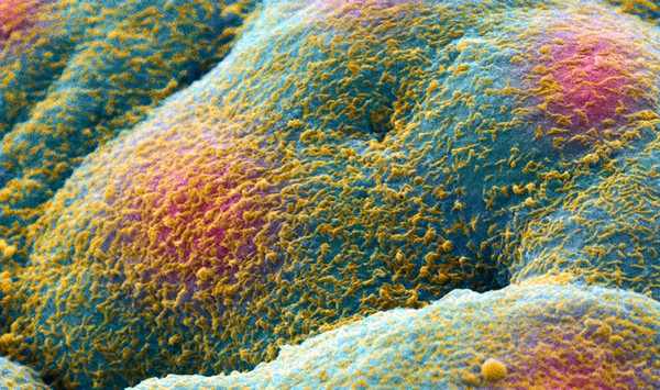 Prostate cancer cell spheroid, SEM