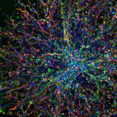 Highly invasive human paediatric brain tumour derived cells