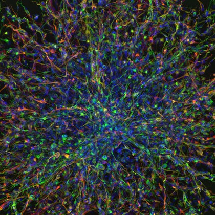 Highly invasive human paediatric brain tumour derived cells