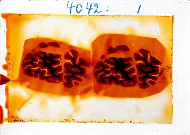 Antique brain tissue, St Elizabeth's Hospital, Washington DC