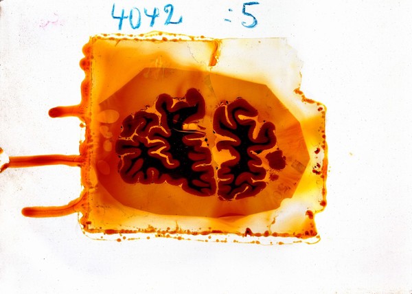 Antique brain tissue, St Elizabeth's Hospital, Washington DC