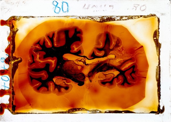 Antique brain tissue, St Elizabeth's Hospital, Washington DC