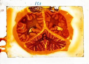 view Antique brain tissue, St Elizabeth's Hospital, Washington DC