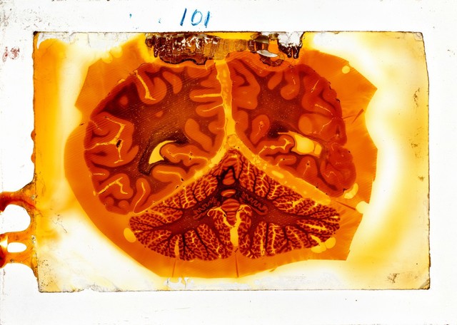 Antique brain tissue, St Elizabeth's Hospital, Washington DC