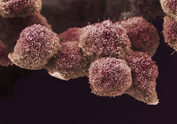Pancreatic cancer cells grown in culture, SEM