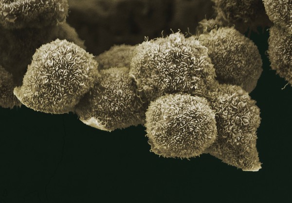 Pancreatic cancer cells grown in culture, SEM