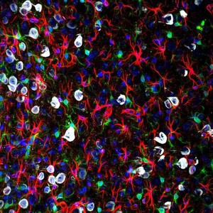 view Neurofibrillary tangles in cerebral cortex, micrograph