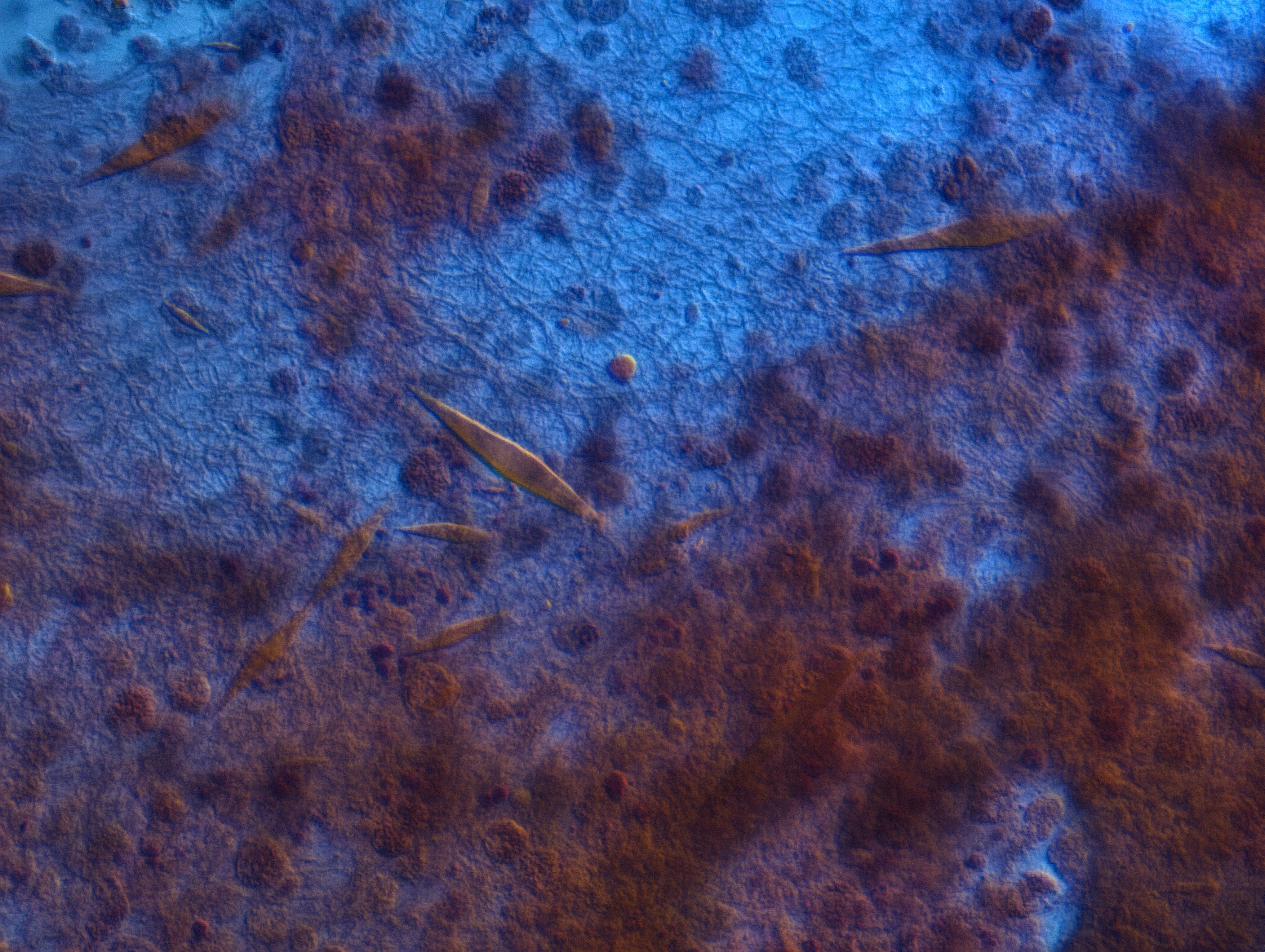 Charcot Leyden crystals from an endobronchial lesion ...