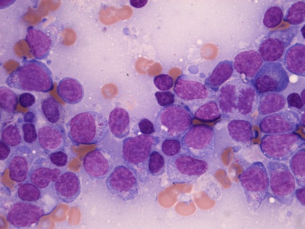 NK T-cell lymphoma is a highly aggressive cancer of a specific type of immune cell called lymphoid cells, and is associated with the Epstein Barr virus (glandular fever). In later stages of the disease, the lymphoma can spread to the lymph nodes, as in this case. 