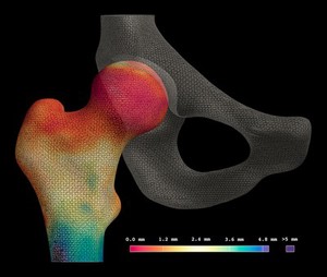 view Cortical bone mapping of hip from computed tomography