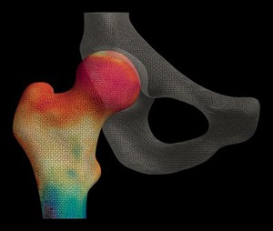 view Cortical bone mapping of hip from computed tomography (CT)