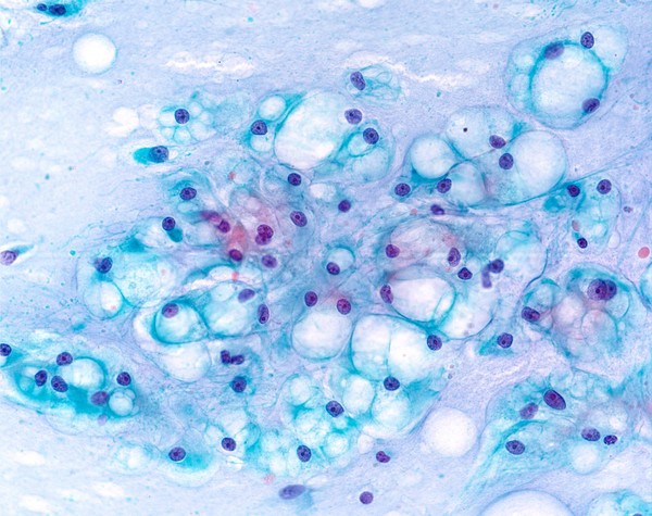 Papanicolaou stained smear of a clival chordoma, microscopy. Chordomas are cancers formed of cells which resemble those of the notochord (spine) of a developing foetus. Although they can present anywhere within the spine and skull, the majority grow in the sacral region of the spine, corresponding to the lower back. This image shows a Papanicolaou (Pap) stained smear obtained from a needle biopsy of a chordoma in the clivus, a part of the cranium at the base of the skull.