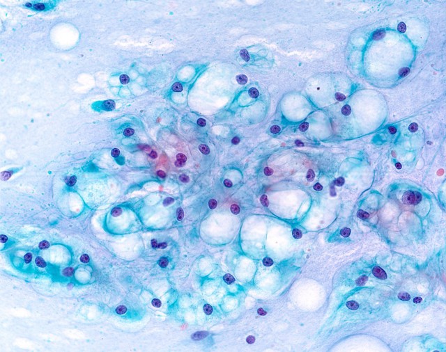 Papanicolaou stained smear of a clival chordoma, microscopy. Chordomas are cancers formed of cells which resemble those of the notochord (spine) of a developing foetus. Although they can present anywhere within the spine and skull, the majority grow in the sacral region of the spine, corresponding to the lower back. This image shows a Papanicolaou (Pap) stained smear obtained from a needle biopsy of a chordoma in the clivus, a part of the cranium at the base of the skull.