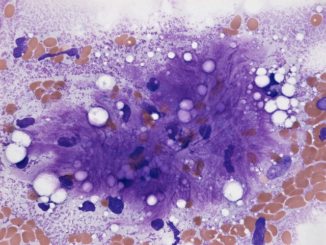 Myxoid liposarcoma, microscopy