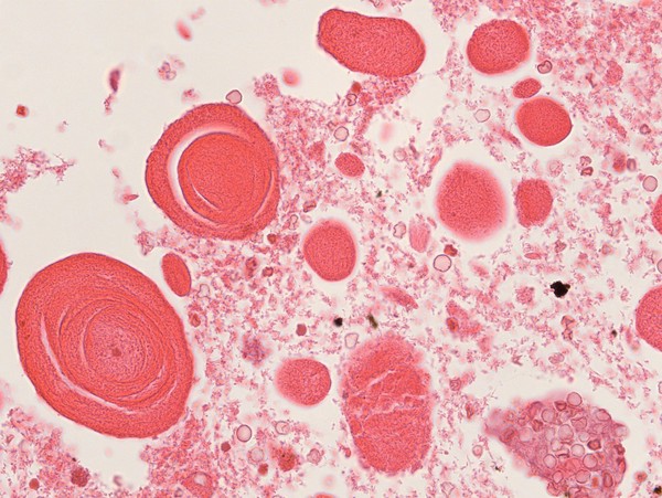 Section of a cystic mass isolated from the parotid gland